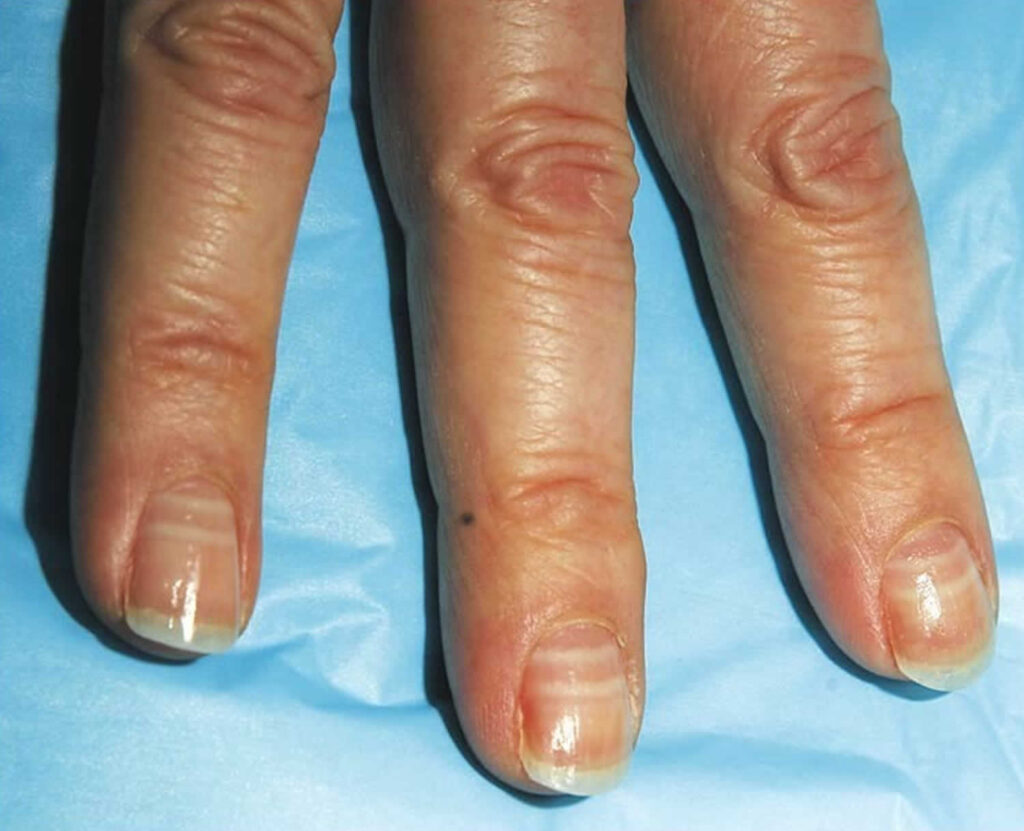 <ol><li><p><span style="color: rgb(29, 147, 96);"><strong>edema</strong></span></p></li></ol><ul><li><p><span style="color: rgb(21, 24, 23);">periorbital </span><span style="color: rgb(29, 147, 96);">(<strong>face</strong>)</span></p></li><li><p><span style="color: rgb(11, 14, 13);">generalized </span><span style="color: rgb(29, 147, 96);"><strong>anasarca </strong>(<strong>abdomen, genitals, legs</strong>)</span></p></li></ul><ol start="2"><li><p>weight <span style="color: rgb(244, 105, 105);"><strong>gain</strong></span></p></li><li><p><span style="color: rgb(105, 74, 239);"><strong>ascites</strong></span></p></li><li><p><span style="color: rgb(192, 172, 46);"><strong>frothy dark</strong></span> urine</p></li><li><p>pallor <span style="color: rgb(225, 68, 183);"><strong>white lines</strong></span> in nails (Muehrcke)</p></li><li><p><span style="color: rgb(79, 140, 219);"><strong>anorexia</strong></span></p></li><li><p><span style="color: rgb(222, 90, 90);">lethargic/irritable/fatigue</span></p></li></ol><p></p>