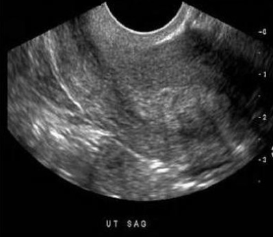 <p>Where is the fibroid located in the uterus?</p><p>A. anterior fundal</p><p>B. posterior fundal</p><p>C. anterior cervix</p><p>D. posterior body</p>