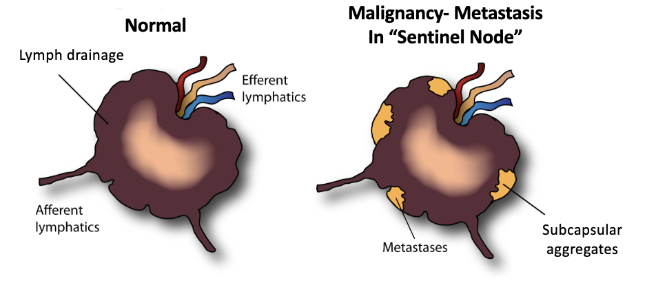 <p>In the <strong>subcapsular region/sinus</strong></p>