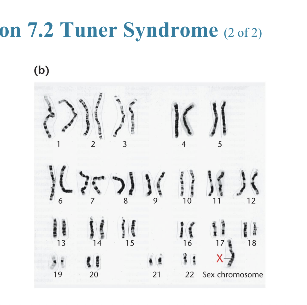 <ul><li><p>Turner syndrome (45,X)</p></li></ul><p></p>