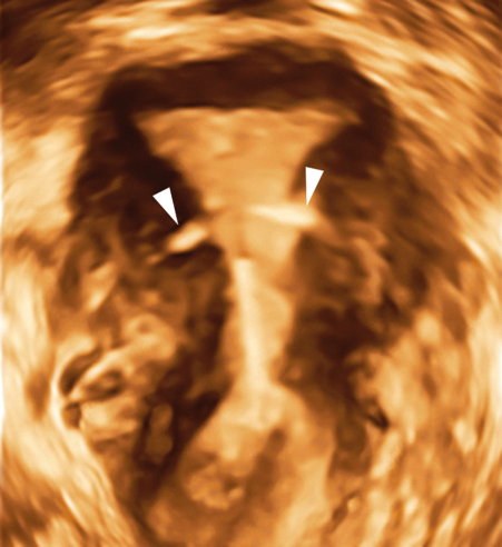 <p>19. The patient in Figure 21-28 presented with a lost IUD string and vaginal bleeding. What is the most likely diagnosis?</p><p>a. The IUD is located within the endometrium.</p><p>b. The IUD is located within the myometrium.</p><p>c. The IUD is located within both the endometrium and the myometrium.</p><p>d. The IUD is located within the endometrium, myometrium, and through the perimetrium.</p>