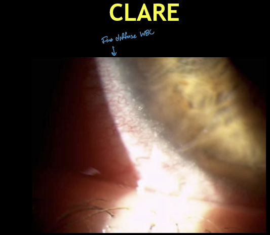 <ul><li><p>Usually unilateral</p></li><li><p>Multiple small infiltrates or diffuse WBCs</p></li><li><p>Location: just inside the limbus</p></li><li><p>Usually no fluorescein staining (intact epithelium)</p></li></ul><p></p>