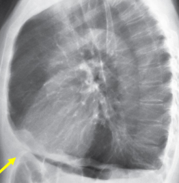 <p>Severe overinflation of lungs along with flattening and even a superiorly concave configuration of the hemidiaphragms.</p>