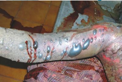 <p>Questions</p><ol><li><p>What postmortem change is characterized by these features?</p></li><li><p>What is the typical timeframe for this change to appear?</p></li><li><p>What is the main differential diagnosis (D.D.) for this condition?</p></li></ol><div data-type="horizontalRule"><hr></div><p></p><p></p>