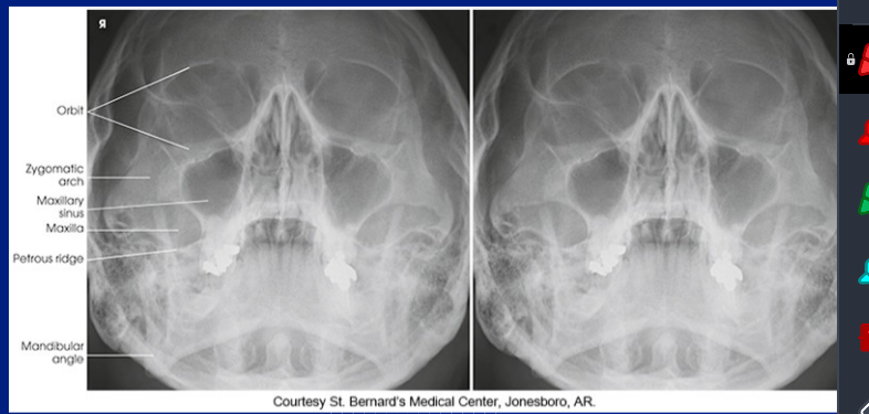 <p>full septum </p><p>pet ridges below floor of maxillary sinus</p><p>orbitszygo arch</p><p>max sinus</p><p>maxilla </p><p>pet ridges</p><p>mand angle</p>