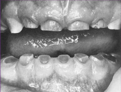 <p>-Enamel splits away from dentin</p><p>-amber translucent color is common </p><p>-severe attrition</p>