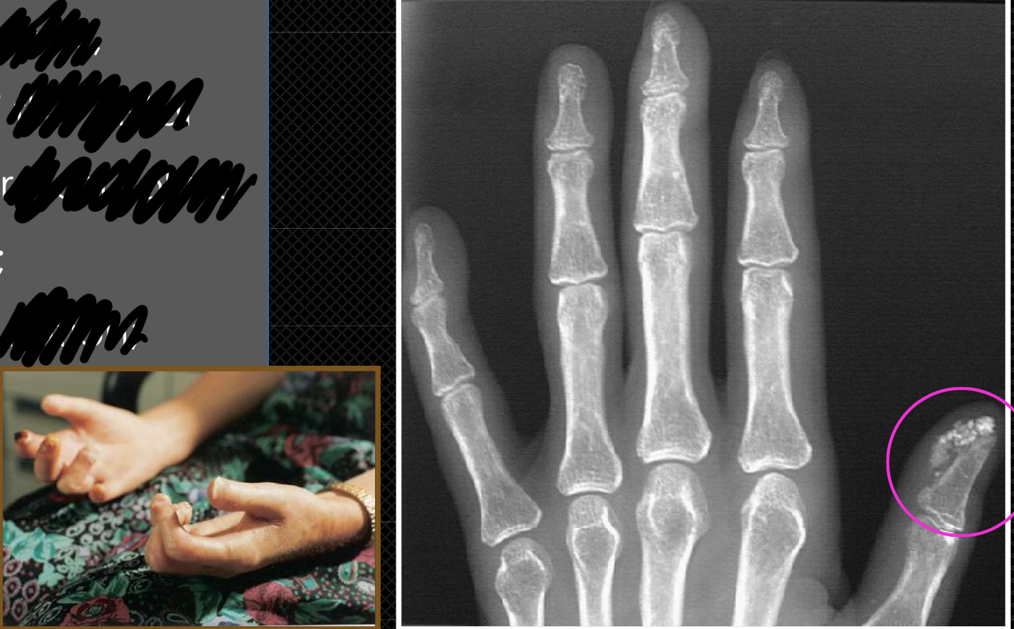 <p>Scleroderma (PSS) in hands</p>
