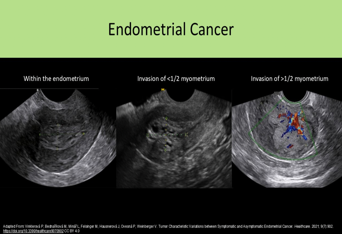 <p>B. myometrium in the body of the uterus</p><p>Stage 0 = precancerous cells</p><p class="p1">Stage | = confined to the body of the uterus (invades myometrium)</p><p class="p1">Stage Il = extends into the cervix</p><p class="p1">Stage Ill = extends into true pelvis</p><p class="p1">Stage IV = metastasis</p>