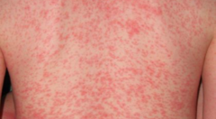 <p>- Wearing clean, light and loose fitting clothing</p><p>- Avoid sweat-generation situations</p><p>- Use of talc or baby powder is of no benefit</p>