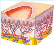 <p>only the epidermis is lost, leaving deeper layers intact</p><p>an ulceration or loss of substance that occurs on the skin or mucous membrane</p>