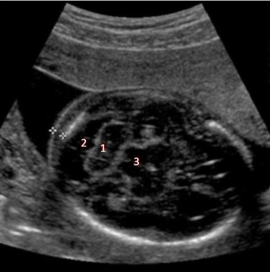 <p>What fetal structure is indicated by #2?</p><p>A. cisterna magna</p><p class="p1">B. nuchal skin fold</p><p class="p1">C. caudate nucleus</p><p class="p1">D. cerebellum</p>