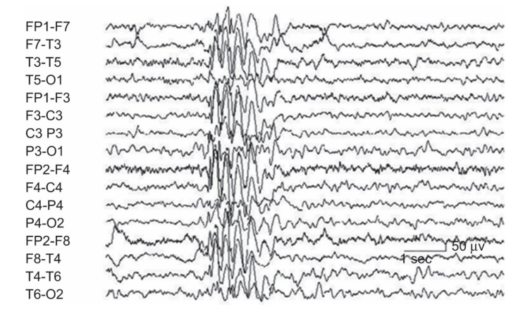 <p>EEG can detect abnormal brain states, such as epilepsy</p><ul><li><p>in epilepsy, large quantities of neurons fire randomly at once</p></li></ul><p></p>