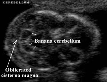 <p>banana sign </p><ul><li><p>(curved cerebellum)</p></li></ul><p></p>