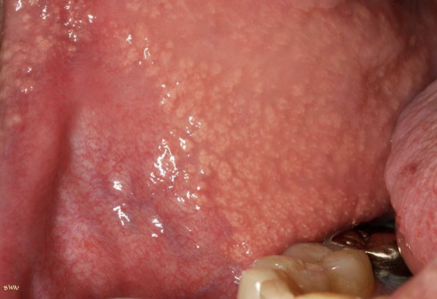 <p>clusters of “ectopic” sebaceous glands; 80% of the population </p>