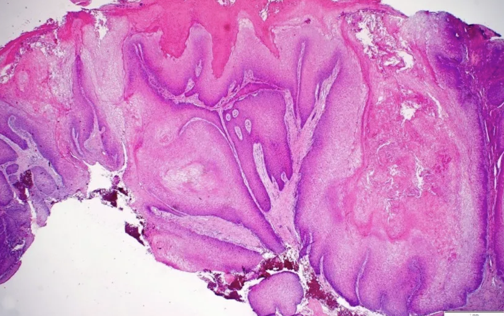 <p>Tumeur de l’oesophage </p><p>1) Diagnostic</p><p>2) Histologie</p>
