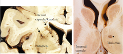 <p>What is a lacunar infarct?</p>