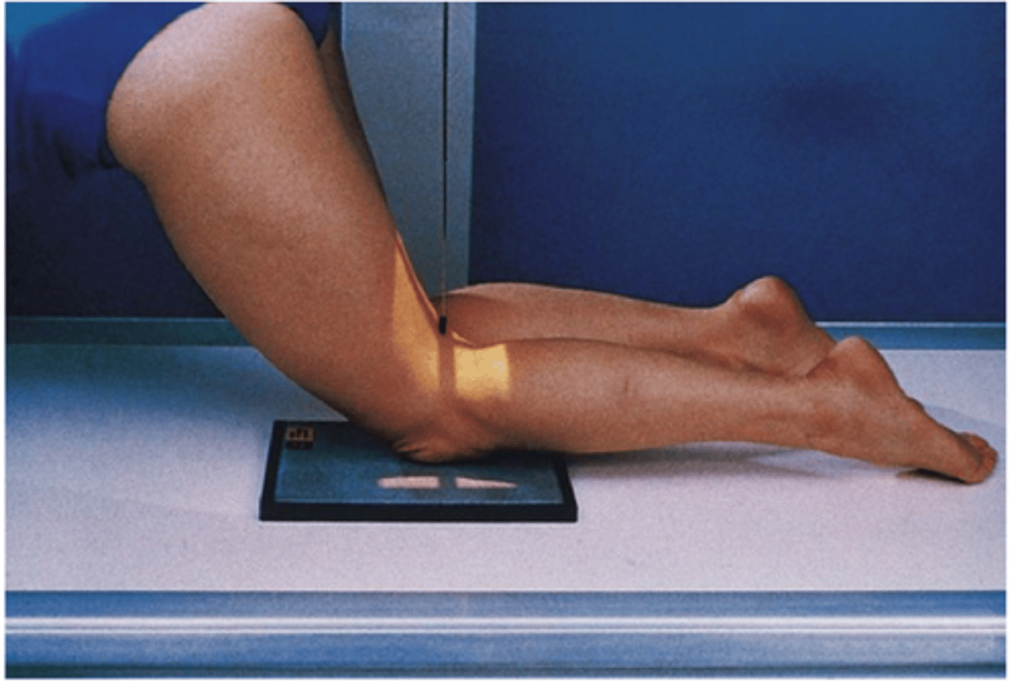<p>S - over butt</p><p>T - 5 mAs @ 65 kVp</p><p>A - none</p><p>M - correct marker on cassette</p><p>P - PT on hands and knees w/ imaged leg extended slightly, CR to popliteal crease</p><p>S - 40"</p><p>B - suspension</p><p>C - 10 x 12 lengthwise</p>