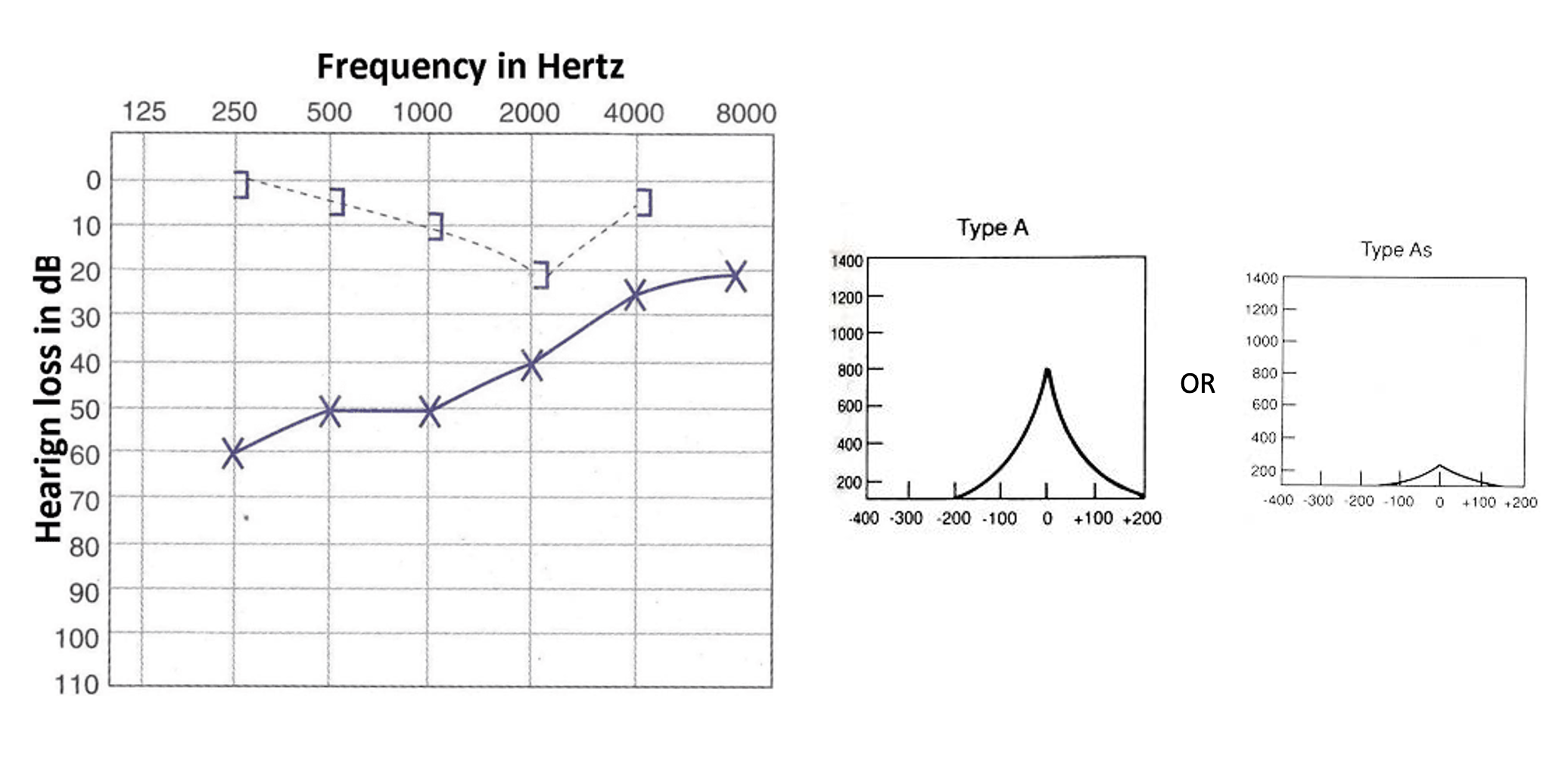 <p>Absent acoustic reflexes </p>