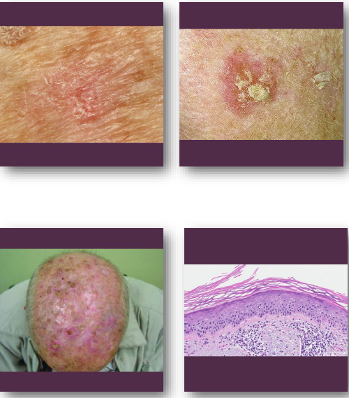 <p>•<strong>Premalignant lesion caused by chronic UV exposure</strong></p><p>•Represents early epithelial dysplasia of skin</p><p><strong>•Strongly associated with sun-damaged skin</strong></p><p>•Precursor to cutaneous squamous cell carcinoma</p><p><strong>•Common in fair-skinned older adults</strong></p>