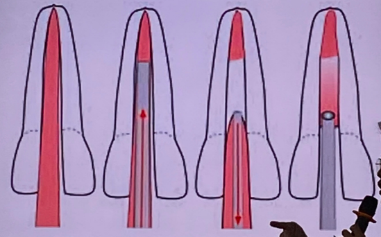 <p>a variation of warm vertical compaction using a<span style="color: red;"> heated plugger to down-pack gutta-percha</span> in one continuous motion</p>