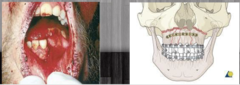 <p>results in a group of teeth being dislodged</p>