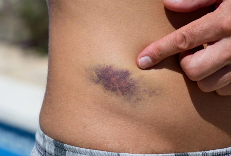 <p><span style="color: red;"><strong>Iliac Crest Contusion: </strong></span>Hip Pointer</p>