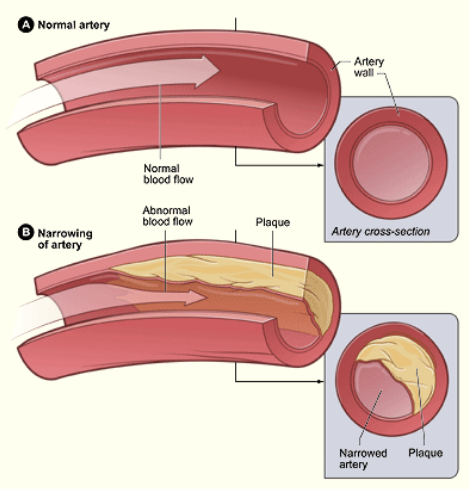 <p>the thickening of artery walls due to the buildup of fatty deposits (plaques) from dmg to endothelial lining</p>