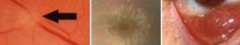<p>2 Ocular Findings in Tuberous Sclerosis</p>