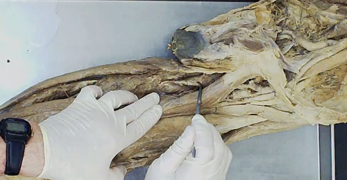 <p>Deep to adductor longus (where he is pointing)</p>