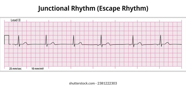<p>Junctional escape rhythm </p>