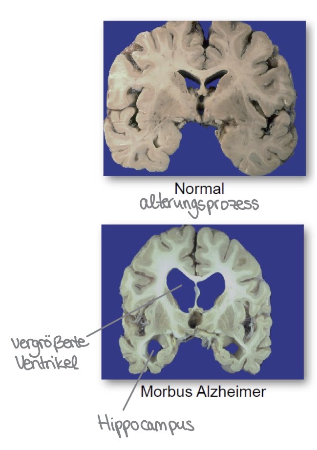 <ul><li><p>1901- Alois Alzheimer behandelte 51 jährige Patientin Auguste Deter in der städtischen Anstalt für Irre und epileptische und Frankfurt am Main </p></li><li><p>Sie konnte sich zu diesem Zeitpunkt an kaum mehr Als ihren Vornamen erinnern und war misstrauisch, aggressiv und empfindlich </p></li><li><p>1906 NAch ihrem Tod im Alter von 56 Jahren untersuchte er im Gehirn und entdeckter die charakteristischen Makro- und mikroskopische Veränderungen für Erkrankungen </p></li><li><p>1907 Er macht seine Entdeckung in der Schrift “Über eine eigenartige Erkrankung der Hirnrinde” öffentlich </p></li><li><p>Neurogenese (neue Zellen gebildet) des Hippocampus durch Gitstoffe stark einggeschränkt </p></li></ul><p></p>
