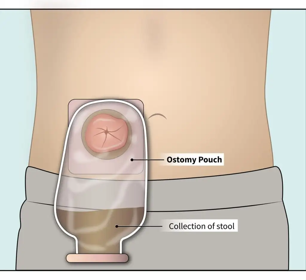 <p>Define ostomy</p>