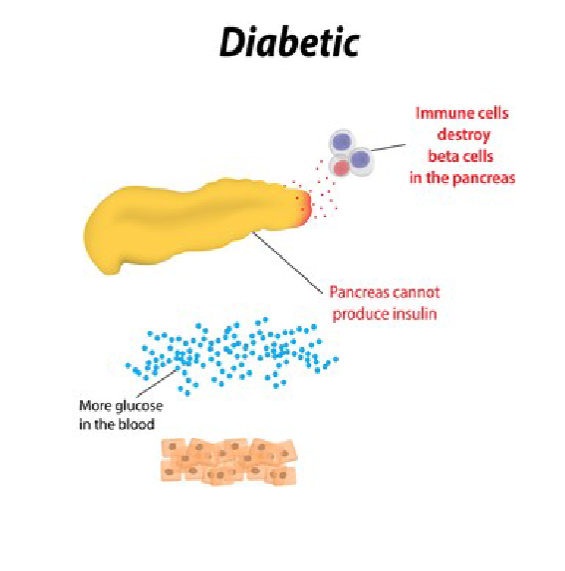 <ul><li><p>beta cells in the islets of Langerhans are destroyed and cannot produce insulin</p></li><li><p>degeneration of beta cells can begin in infancy</p></li><li><p>often diagnosed during childhood</p></li><li><p>requires close monitoring and daily treatment of insulin</p></li></ul><p></p>