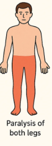 <p><span style="background-color: transparent;"><strong>lower half of the body paralyzed</strong></span></p><p><br></p>