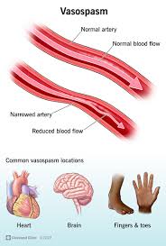 <p>What is vascular spasm?</p>