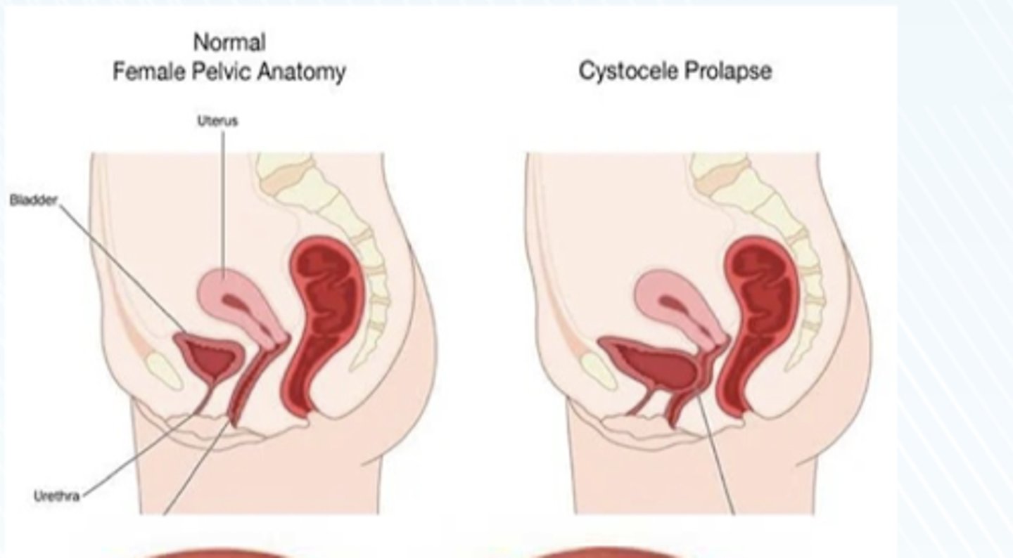 <p>Bladder prolapse</p>