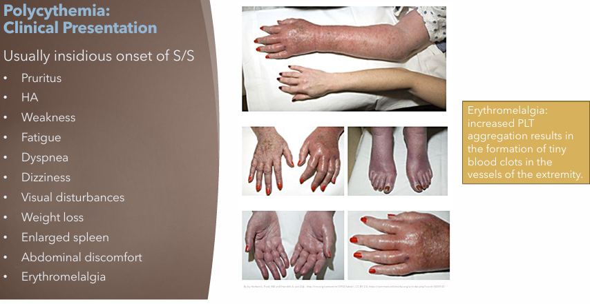 <p>Usually insidious onset of S/S</p><ul><li><p>Pruritus</p></li><li><p>HA</p></li><li><p>Weakness</p></li><li><p>Fatigue</p></li><li><p>Dyspnea</p></li><li><p>Dizziness</p></li><li><p>Visual disturbances</p></li><li><p>Weight loss</p></li><li><p>Enlarged spleen</p></li><li><p>Abdominal discomfort</p></li><li><p>Erythromelalgia</p><ul><li><p>Increased PLT aggregation → tiny blood clots in extremities vessels</p></li></ul></li></ul><p></p>