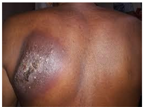 <p>What kind of lesion is this?</p>