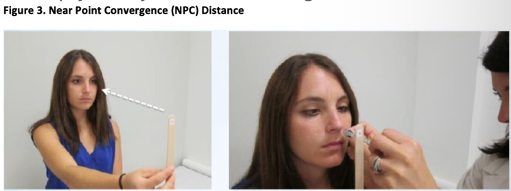 <ul><li><p class="p2"><span>Measures the ability to view a near target w/o double vision</span></p></li><li><p class="p2"><span>Pt instructed to bring pencil w/ writing towards nose</span></p></li><li><p class="p2"><span>Pt instructed to stop moving target when they see 2 distinct images</span></p></li><li><p class="p2"><span>Distance from nose should be ≤ 5 cm</span></p></li><li><p class="p2"><span>“Slowly move the pencil and keep your eyes on the writing”</span></p></li></ul><p></p>