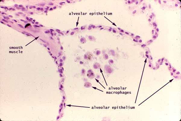 <p><strong>simple squamous</strong> epithelium (95%)</p>
