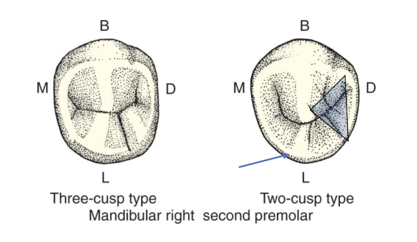 <p>2 cusp type</p><ul><li><p>distal fossa generally larger than mesial</p></li><li><p>lingual cusp tip shifted mesially</p></li></ul><p>3 cusp type</p><ul><li><p>lingual cusp usually subdivided into mesiolingual and distolingual cusps </p></li><li><p>mesiolingual cusp wider and higher distolingual </p></li></ul><p></p>