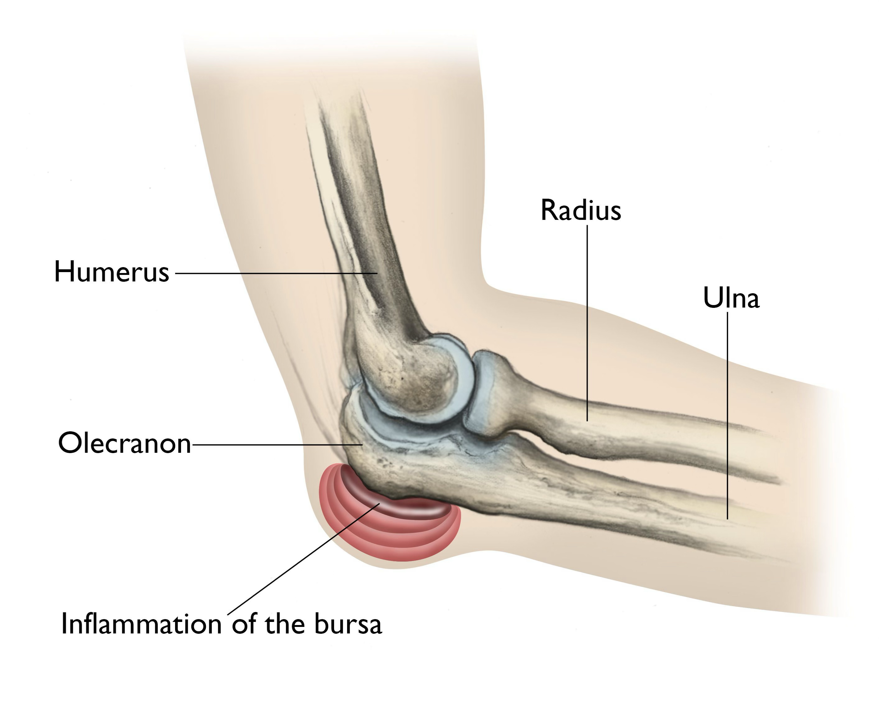 <p>symptoms of olecranon bursitis </p>