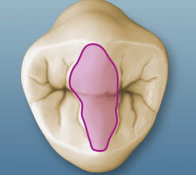 <p>the joining of a buccal and a lingual triangular ridge</p>