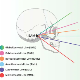 <p>entering inferior part of orbitals exiting EAM</p>