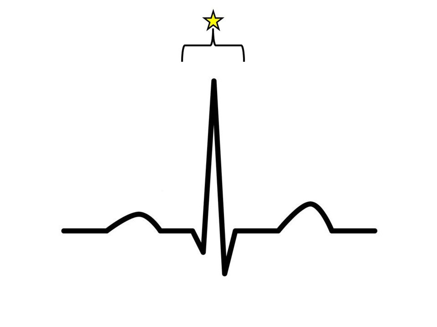 <p>ventricular depolarization; time measured in seconds; height measured in mV</p>