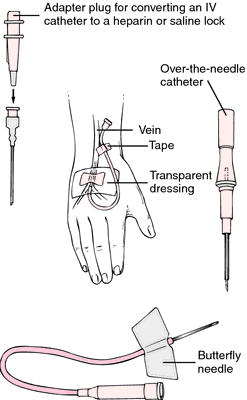 <p>A flush technique or device attachment used to maintain the patency of an IV catheter when no continuous IV drugs are actively running.</p>