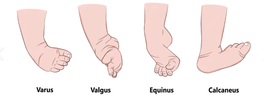 <ol><li><p>talipes <span style="color: rgb(206, 71, 71);"><strong>varus</strong>: inversion</span></p></li><li><p>talipes <span style="color: rgb(38, 166, 40);"><strong>valgus</strong>: eversion</span></p></li><li><p>talipes <span style="color: rgb(85, 122, 234);"><strong>calcaneus</strong>: dorsiflexion</span></p></li><li><p>talipes <span style="color: rgb(174, 160, 49);"><strong>equinus</strong>: plantar flexion</span></p></li></ol><p></p>