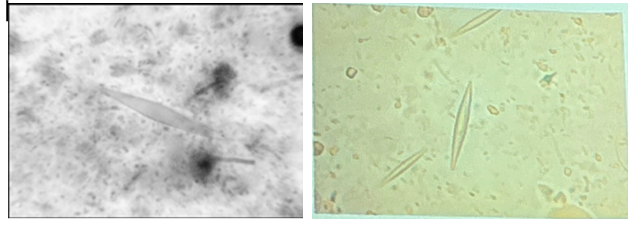 <ol><li><p>Charcot-Leyden Crystal</p></li><li><p>Amebiasis</p></li><li><p>E. histolytica</p></li><li><p>Metronidazole. Tinidazole, Secnidazole</p></li></ol><p></p>