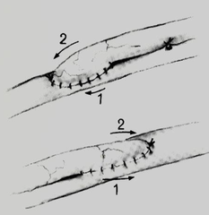 <p>n. a connection made surgically between adjacent blood vessels, parts of the intestine, or other channels of the body, or the operation in which this is constructed.</p>