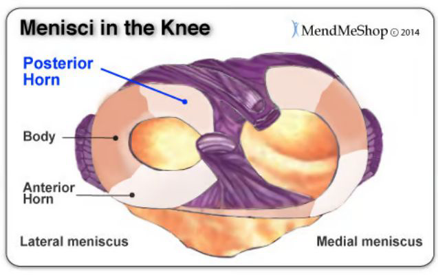 <p></p><ul><li><p>Areas of greater blood flow = higher likelihood of success / healing</p></li><li><p><strong>Example:</strong></p><ul><li><p>A patient who has a red-to-red tear and gets a surgical procedure is clinically sound and has a good likelihood of recovery and a positive outcome</p></li><li><p>On the other hand, a patient who has a white-to-white meniscal tear and receives a surgical procedure has a much poorer outcome with surgery (and the decision to have surgery may not be clinically sound)</p></li></ul></li></ul><p></p>
